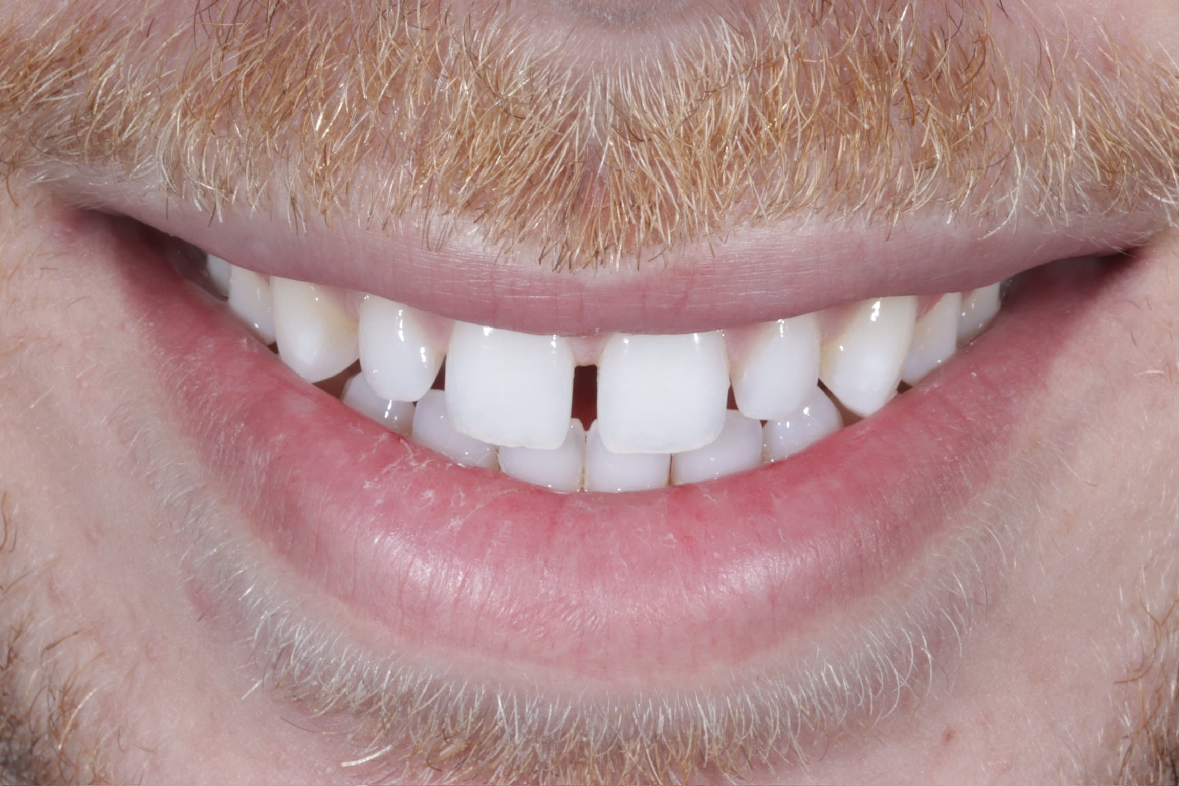 Before